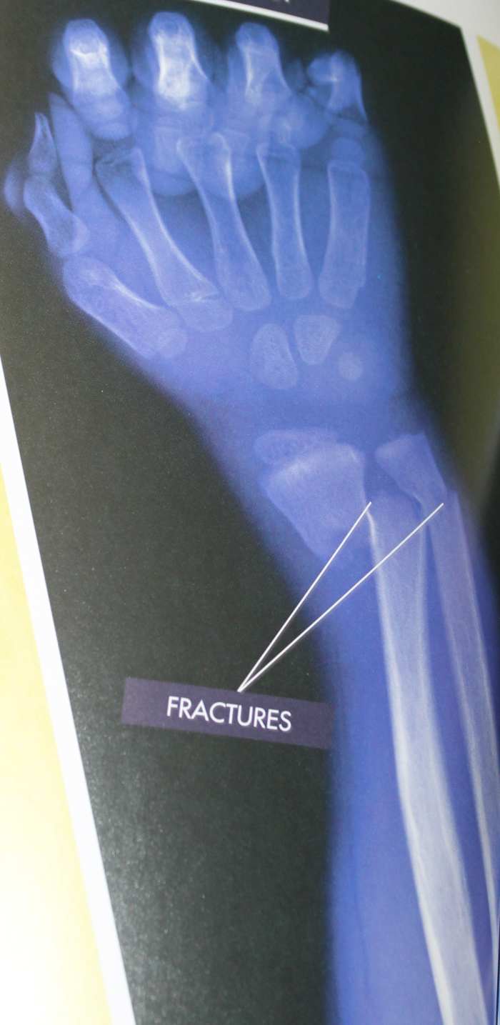X-Ray of a Fracture from the below book "Your Body Battles a Broken Bone"